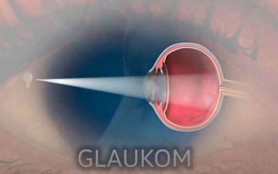 “Eliksir” – Vrste glaukoma, dr Snežana Vlajković